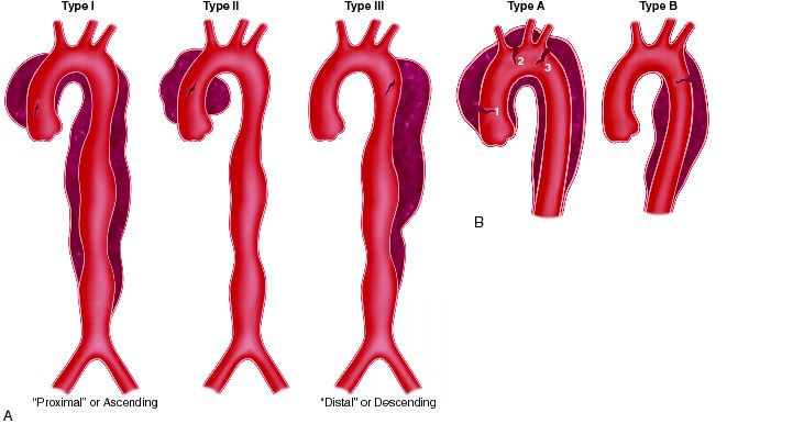 dissection-Thoracic-aneirysms.jpg
