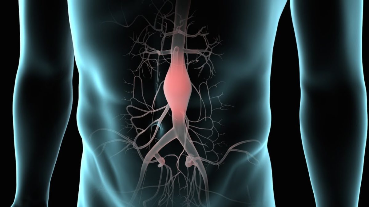 anevrisma-kiliakis-aortis-1200x675.jpg